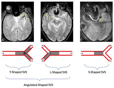 Impact of Clot Shape on Successful M1 Endovascular Reperfusion